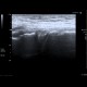Degeneration of meniscus: US - Ultrasound